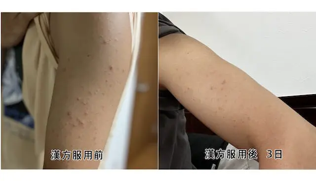 蕁麻疹、漢方服用後の経過観察